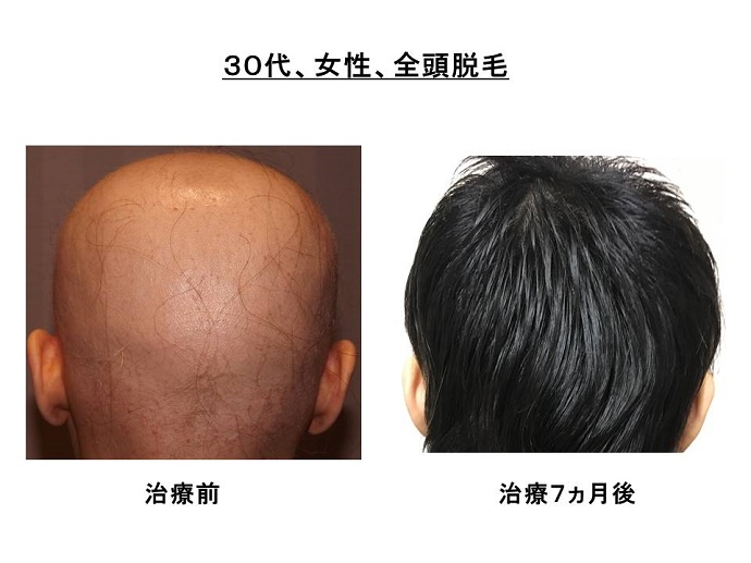 円形脱毛症　病院""